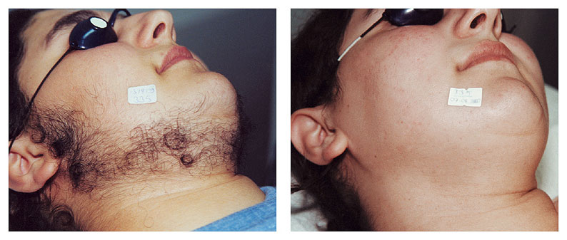 Laser Hair Removal Laser Hair Removal